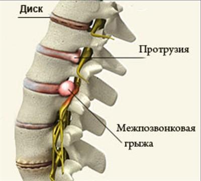 Секвестрация грыжи диска: что это такое, симптомы и лечение, поражение поясничного отдела