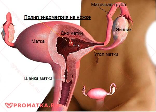 Полипы в матке
