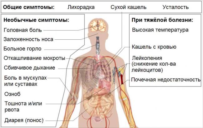 Пневмония (воспаление легких) у взрослых без температуры — причины, симптомы и лечение