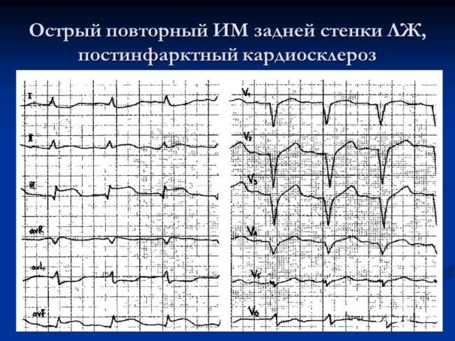 Что же такое атеросклеротический кардиосклероз в ибс