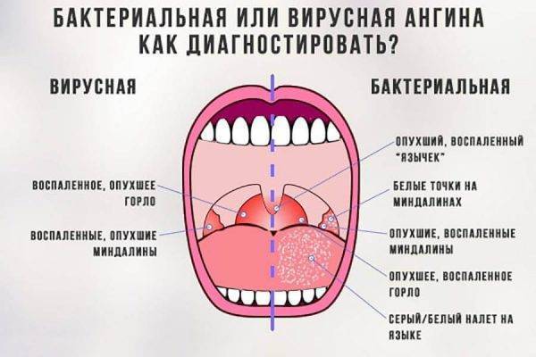 Как полоскать горло фурацилином? как правильно развести? инструкция и отзывы