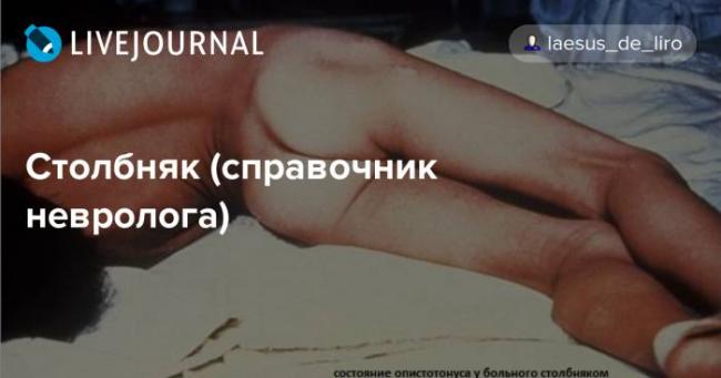 Столбняк