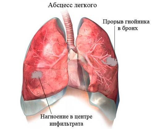 Слюна с кровью: причины, рекомендации по лечению | food and health