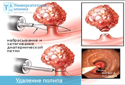 Полип шейки матки
