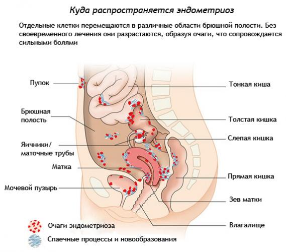 Аденомиоз матки – диффузный и узловой, симптомы и признаки, алгоритм лечения, народные средства