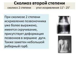 Как определить сколиоз на ранней стадии