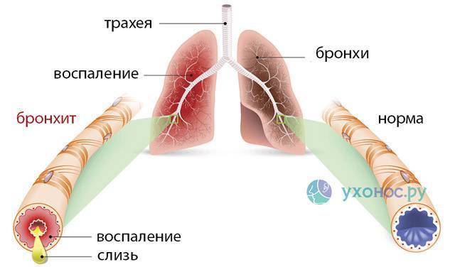 Болит горло при отхаркивании сгустки крови