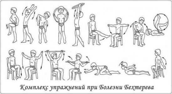 Анкилозирующий спондилит (болезнь бехтерева)