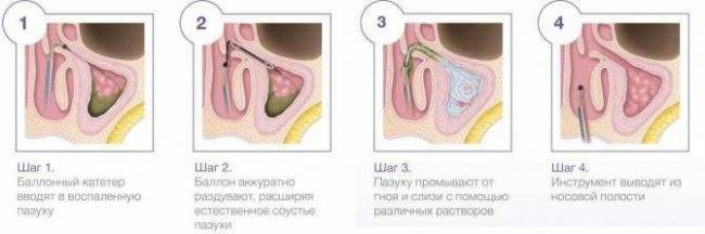 Септопластика носа: цели и показания, как проходит, виды, рекомендации пациентам