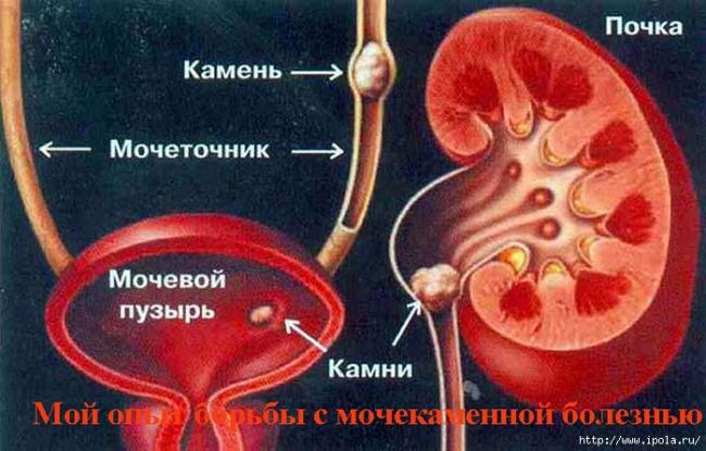 Чем лечить песок в почках