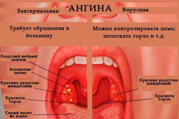 Острый тонзиллит (j03)