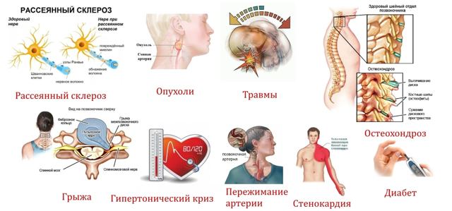 Почему немеет голова и бегают мурашки: причины онемения, симптомы, лечение
