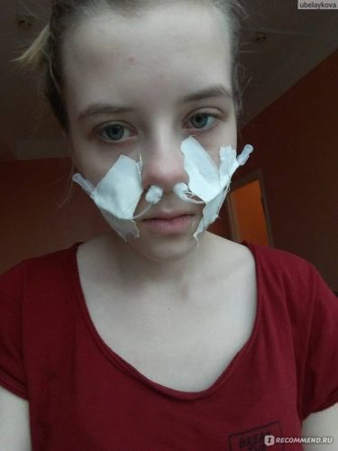 Двухсторонний гайморит, лечение острого гнойного двустороннего синусита гайморовых связок у взрослых в домашних условиях