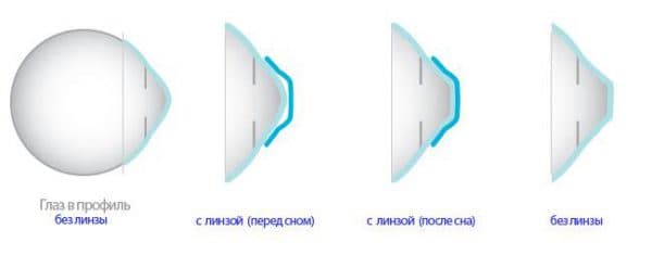 Торические контактные линзы что это такое