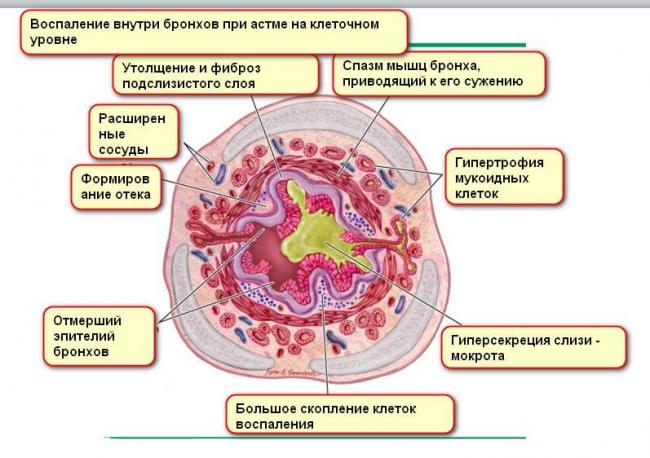 Диета при бронхиальной астме у взрослых