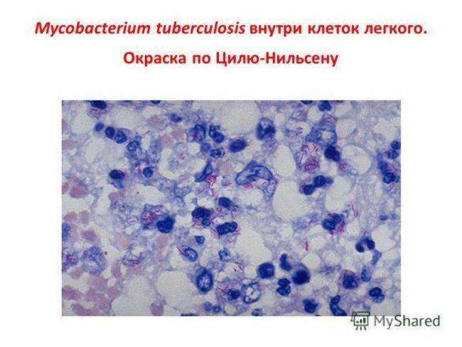 Лекарственная устойчивость микобактерий туберкулеза – современные взгляды на проблему