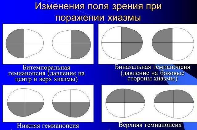 Лечение гемианопсии после инсульта