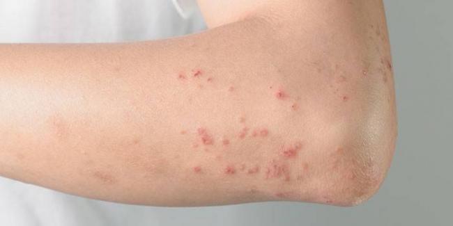 Micoderm от грибка: мгновенно действует, активно уничтожая микробы!