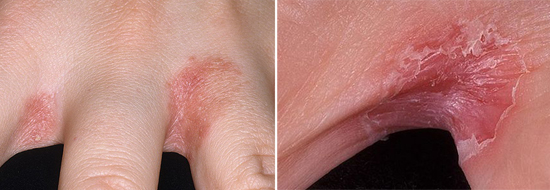 Как справиться с грибком на пальцах рук: методы лечения