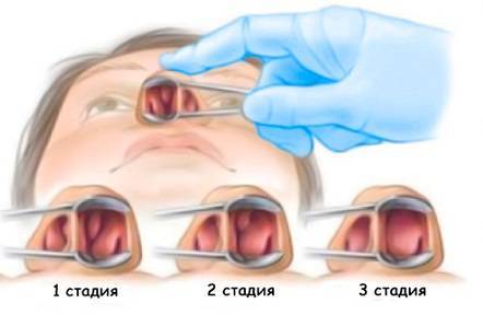 Лечение народными средствами полипов носа (полипоза)