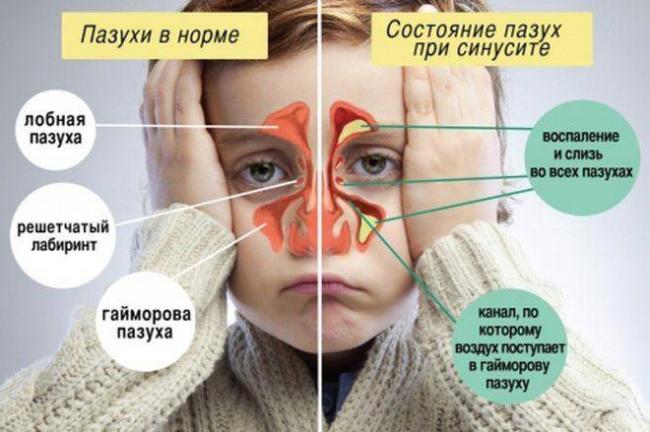 Кто нибудь высасывал ребенку сопли ртом?