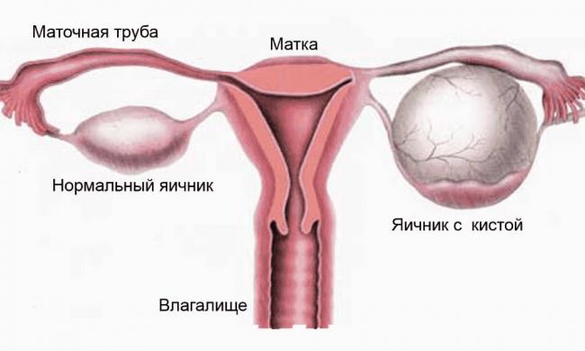 Киста правого яичника: что это такое и как ее лечить