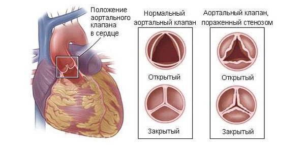 причины, признаки, симптомы и лечение