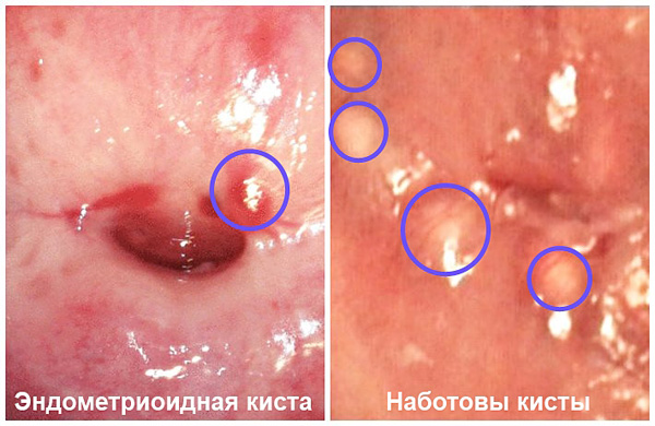 Какие бывают единичные кисты шейки матки?
