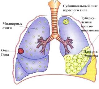 Туберкулез у взрослых — симптомы, первые признаки