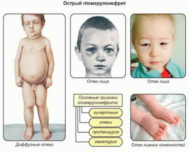 Внутричерепное давление у грудничков: лечение при симптомах
