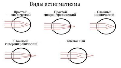 Чем отличается астигматизм от близорукости