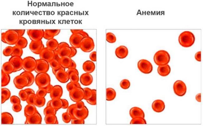 Орви без температуры