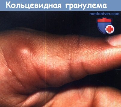Чем опасна кольцевидная гранулема у детей. причины, симптомы и лечение кольцевидной гранулемы. какой врач лечит кольцевидную гранулему