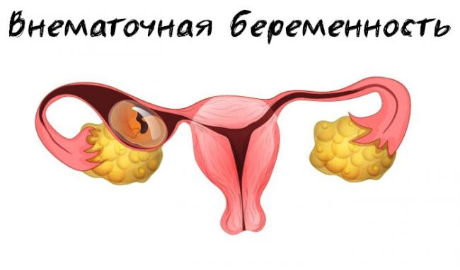 Внематочная беременность – последствия всех видов развития плода вне матки