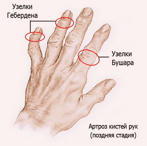 Артрит пальцев рук и кистей