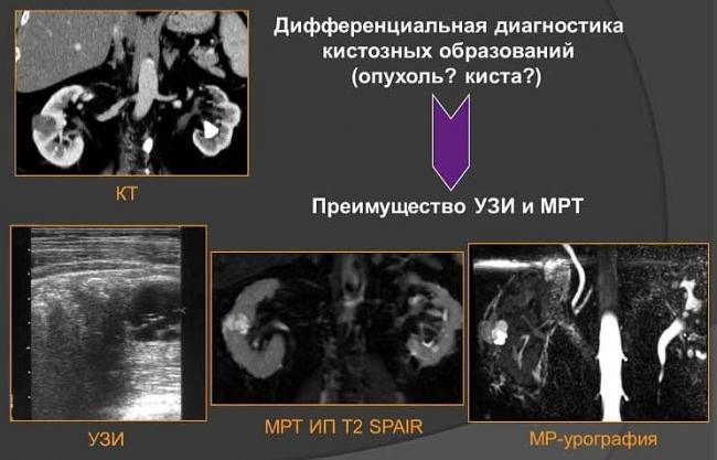 Кисты обеих почек что делать