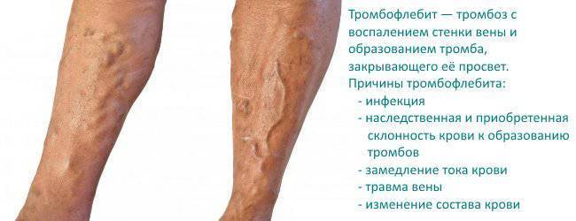 Куда клеить перцовый пластырь при кашле