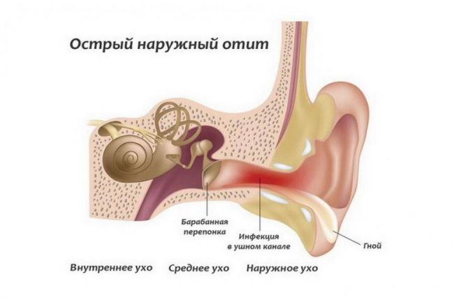 Наружный отит: симптомы, лечение и профилактика