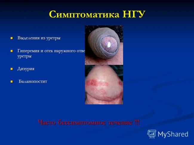 Выделения из уретры: причины и диагностика