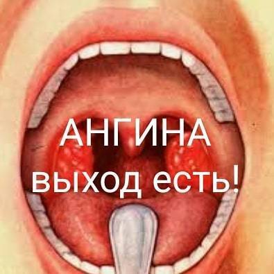 Ангина - комаровский (28 фото): симптомы и лечение герпесной ангины