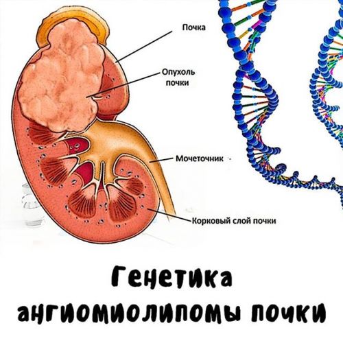Ангиомиолипома: симптомы, лечение и диагностика