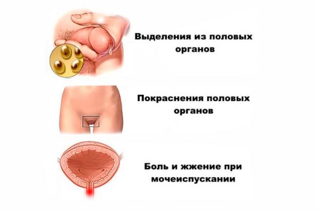 Хламидиоз: причины, симптомы, диагностика и лечение