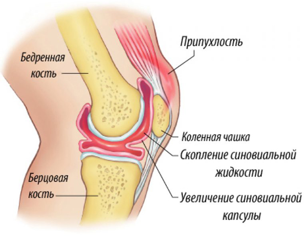 Синовит сустава (коленный, тазобедренный, голеностопный, локтевой, лучезапястный и др.) - причины, симптомы, диагностика и лечение, народные средства