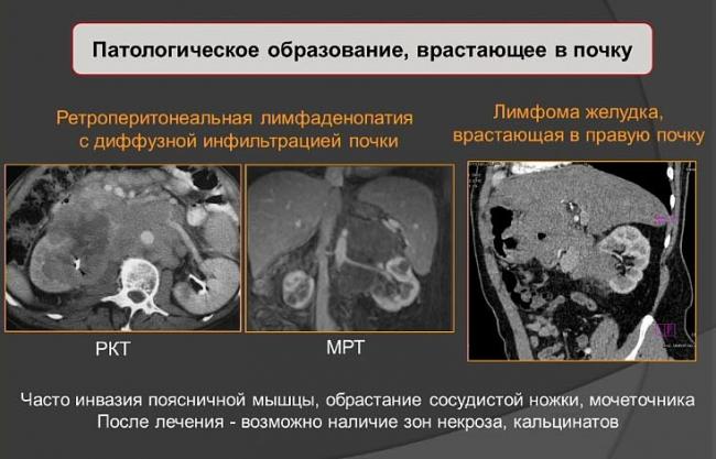 Киста почки: разновидности, причины и симптомы, диагностика и лечение