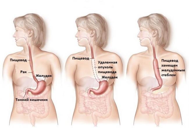 Рак пищевода и желудка что кушать