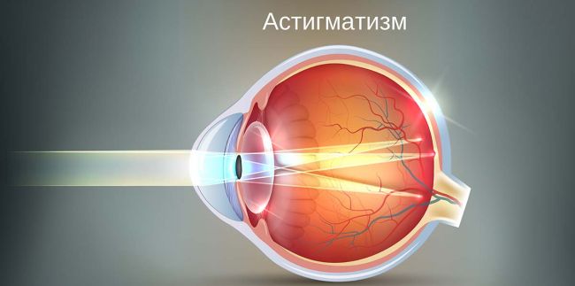 Отличия астигматизма от близорукости миопии