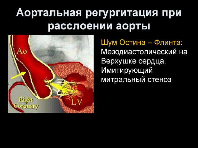 Митральная регургитация: причины, диагностика и лечение
