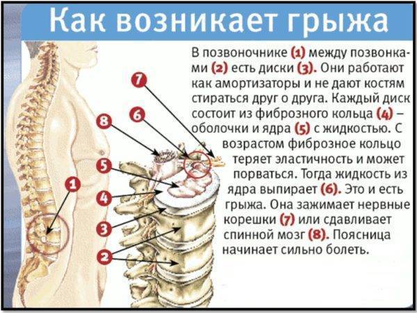 Подводное вытяжение позвоночника при остеохондрозе после обострения