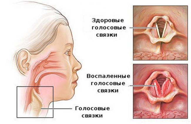 Все о фарингите: хроническая и острая формы болезни горла