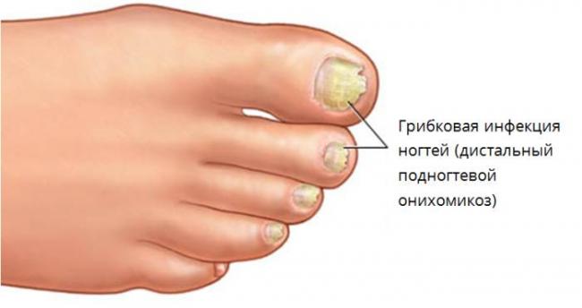 Диагностика по ногтям